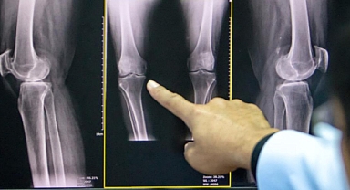 Osteoporozun gizli tehlikeleri: Tanı, tedavi ve önleme yolları