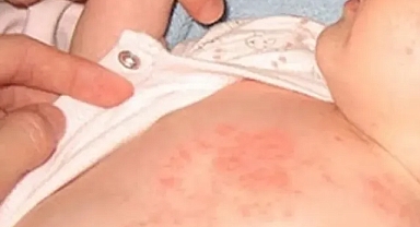 Çocuklarda isilik tehlikesine dikkat