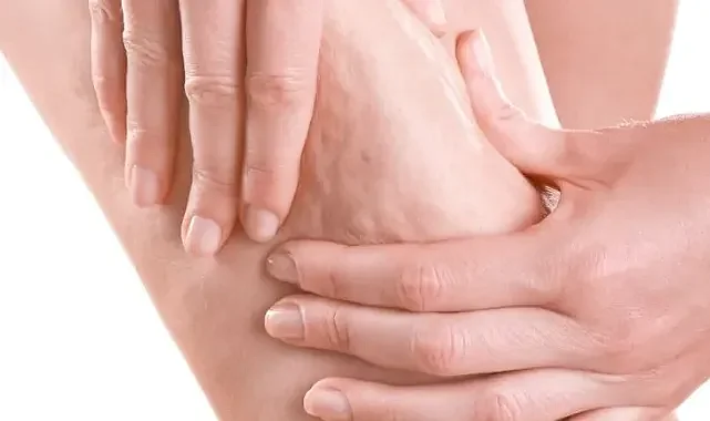 Prof. Dr. Karacalar’dan selülit uyarısı: Portakal kabuğu görüntüsü basit sorun değil!