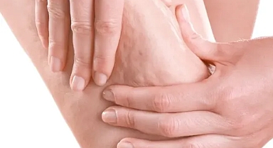 Prof. Dr. Karacalar’dan selülit uyarısı: Portakal kabuğu görüntüsü basit sorun değil!