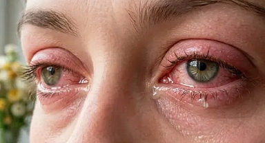 Baharın habercisi... Alerjik Konjonktivit